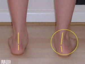一網打盡足底痛 11