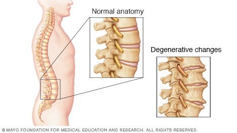 Sciatica Simplified 3 Bone spurs on spine