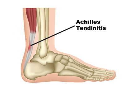 Achilles tendinitis