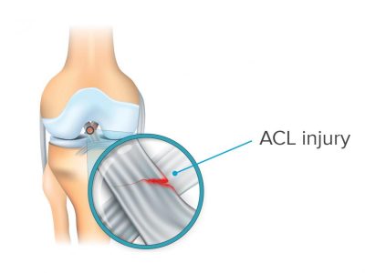 ACL injury