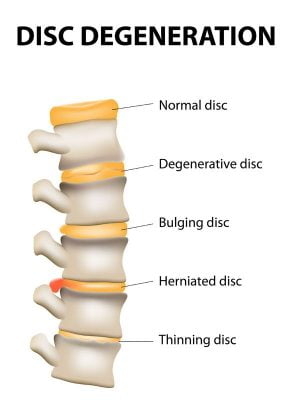 back pain disc degeneration bulging herniated thinning