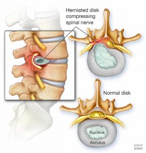 Herniated disk