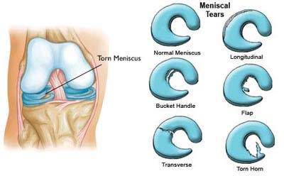 Torn meniscus