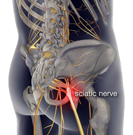 Sciatica Simplified 1 sciatic nerve sciatica
